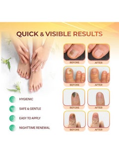 Fungal Nail Patches: Nail Fungus Relief Toenail Fungus Relief Nighttime Renewal Fungal Nail Patches Nail Fungus Improvement Overnight Nail Repair 8Hour Nighttime Renewal 21 Pcs - pzsku/Z64602ACF4A570594E0C2Z/45/_/1721027094/c659051c-ecd7-41b3-9b28-68ef35136ede