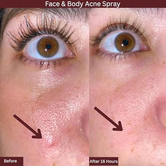 ITK Skincare 2% Salicylic Acid Spray for Face & Body Acne - Blemish-Fighting Treatment for Body Acne, Bacne, Blackheads, Pimples & Blemishes - BHA Blemish Facial Mist Post Workout - 3.3oz Spray Bottle - Image 5