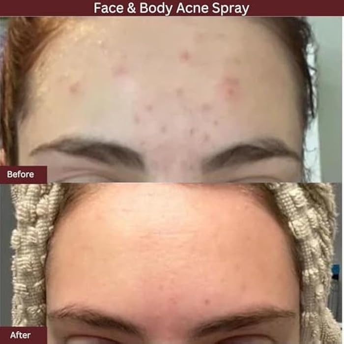 ITK Skincare 2% Salicylic Acid Spray for Face & Body Acne - Blemish-Fighting Treatment for Body Acne, Bacne, Blackheads, Pimples & Blemishes - BHA Blemish Facial Mist Post Workout - 3.3oz Spray Bottle - Image 4