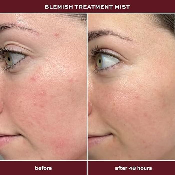 ITK Skincare 2% Salicylic Acid Spray for Face & Body Acne - Blemish-Fighting Treatment for Body Acne, Bacne, Blackheads, Pimples & Blemishes - BHA Blemish Facial Mist Post Workout - 3.3oz Spray Bottle - Image 3