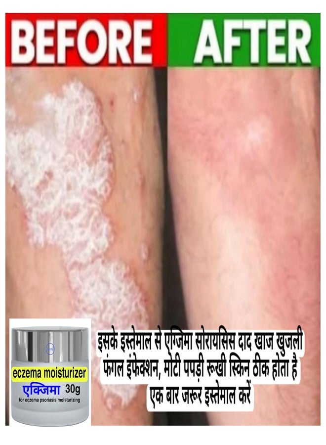 samta Eczema moisturizer - Image 3