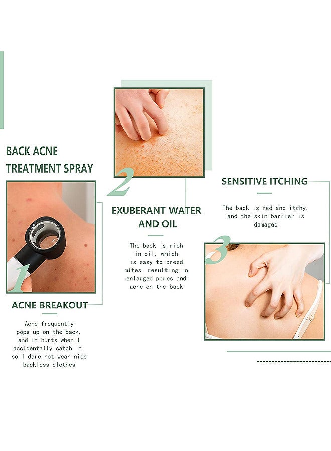EELHOE 120ML Back Acne Treatment Soothing Spay, Back Acne Spray, Niacinamide Spray, Body Acne Treatment with Herbal Formula, Tea Tree Oil Spray, Body Acne Treatment Spray For Teens, Gentle On Skin  - Image 5