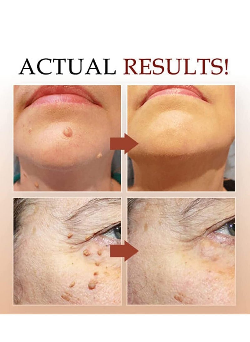 Excefore 3 Pcs Wipe Off Tags and Mole Remover, Skin Tag Remover Mole Remover, Easy to Remove, for All Body Parts, Face Armpit Flesh Neck - Image 3