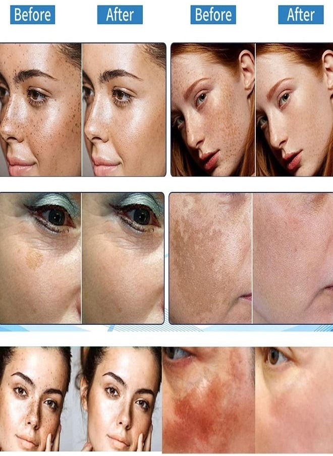 Acne Dark Spot Remover
