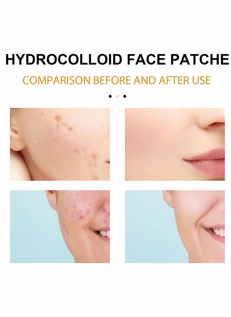 SYOSI - Hydrocolloid Face Mask for Acne, 5 Large Pimple Patches for Zit Breakouts on Nose, Chin, Forehead & Cheeks, Pore Cleansing Strips Acne Patches for All Skin Types (2 Box(40 Pcs)) - Image 1