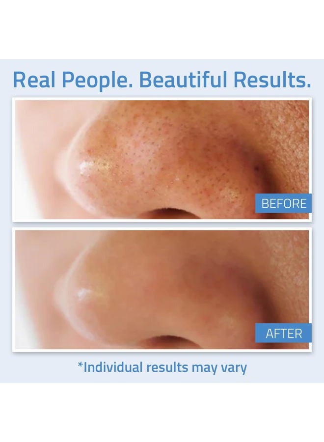 Yeouth Salicylic Acid Peel for Face 20%, BHA Exfoliator for Clear Looking Skin, Gentle At Home Exfoliator for Face with Green Tea, Salicylic Acid Serum 1oz - Image 4