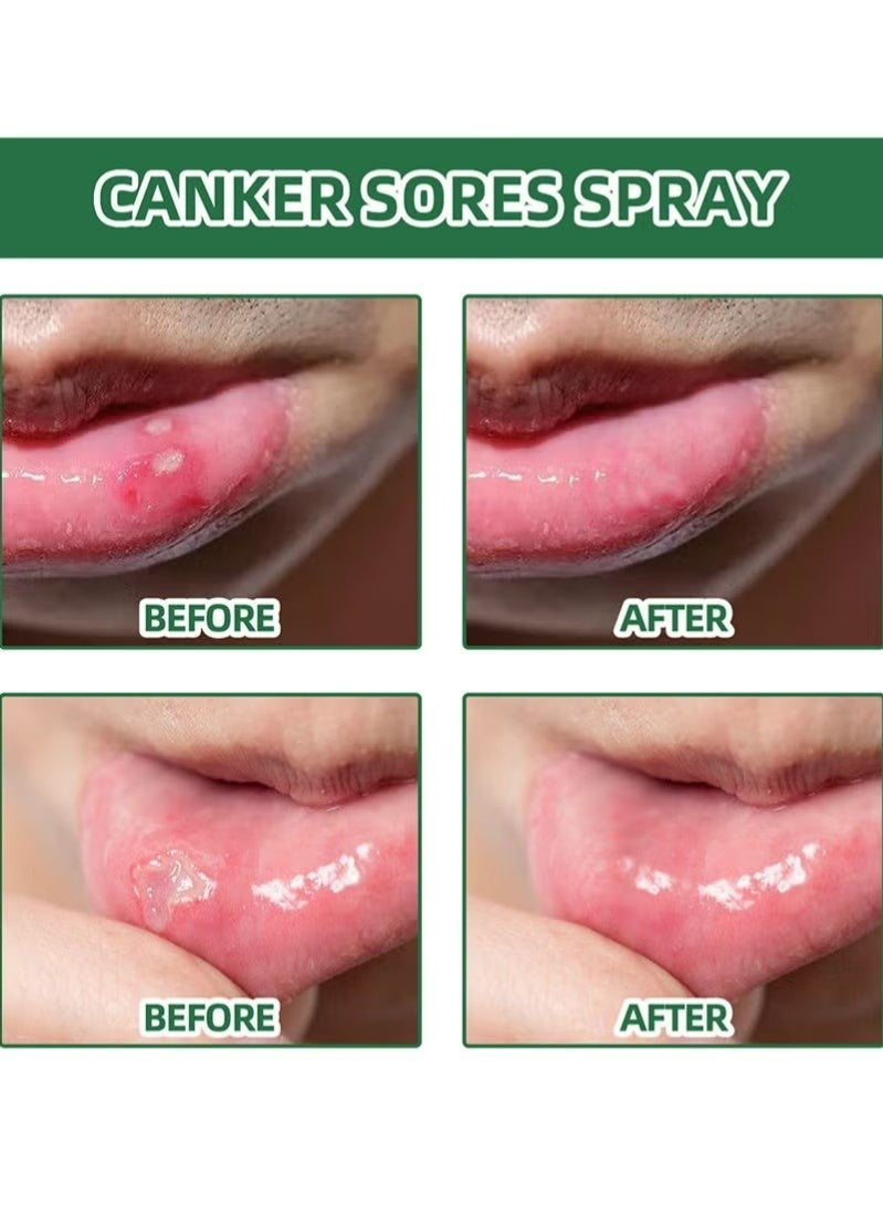ساوث مون تقرحات القرحة، بخاخ الفم المضاد للجراثيم -مطر التنفس، علاج قرحة الفم وتخفيف الألم، بخاخ العناية بالفم العشبي، العمل السريع يخفف من مشاكل الحلق الجاف والفم، فعالة لقرحة الفم - Image 3