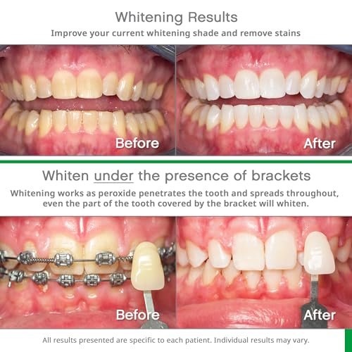Opalescence Go 10 Whitening Bundle Prefilled Gel Whitening Trays  10 Treatments Hydrogen Peroxide 10  Includes Opalescence Whitening Toothpaste Teeth Whitening Kit Mint 51945166 - Image 5