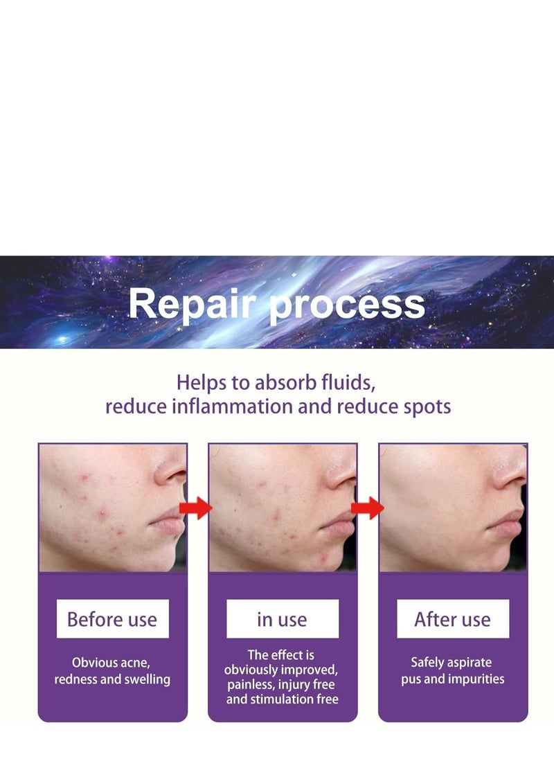 Jaysuing - Star Pimple Patches, 180 Patches, Pimple Patches For Face, Hydrocolloid Acne Patches, Pimple Patches Stars, Zit Patches For Zits, Blemishes, Breakouts, Waterproof And breathable For Acne-prone Skin - Image 1