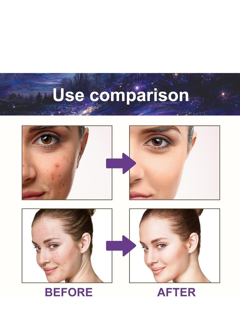 Jaysuing - Star Pimple Patches, 180 Patches, Pimple Patches For Face, Hydrocolloid Acne Patches, Pimple Patches Stars, Zit Patches For Zits, Blemishes, Breakouts, Waterproof And breathable For Acne-prone Skin - Image 1