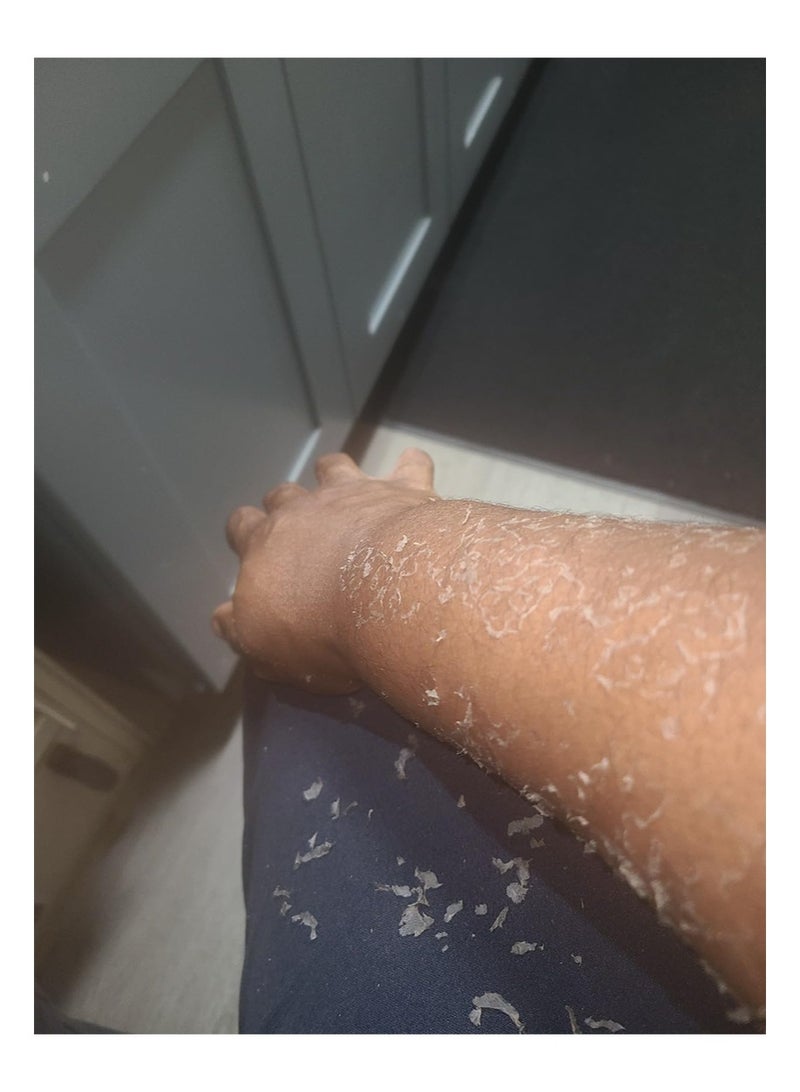 MOOYAM Extra Strong Yellow Peeling Oil for Dark Skin,Yellow Exfoliating Oil,Facial Peeling,Fruit Acid Exfoliator,Body Lightening and Whitening Creams Peeling Oil,Skin Lightening,Hand Oil Scrub,Exfoliant Peels Solution at Home Body Peeling for Exfoliate Body Hand Foot Knuckle All Skin Type Dead Skin Remover (3.66 Fl OZ/110ML) - Image 4