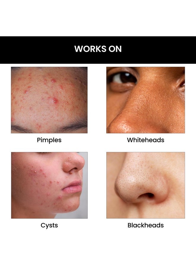 ثريفيكو - غسول الوجه Goodbye Acne™ | يقلل من البكتيريا المسببة لحب الشباب وإنتاج الدهون | للرجال والنساء، 100 مل - Image 1