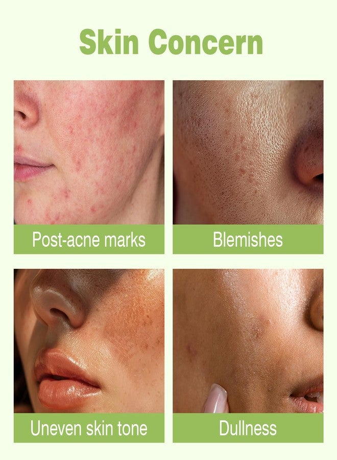 YAFUSIPE 345 Relief Cream, Moisturizer for Acne Scar Recovery with PDRN Niacinamide, Face Acne Cream Treatment for Acne-Prone Scar Skin, Facial Moisturizer for All Skin Women Men - 1.69 floz - Image 4