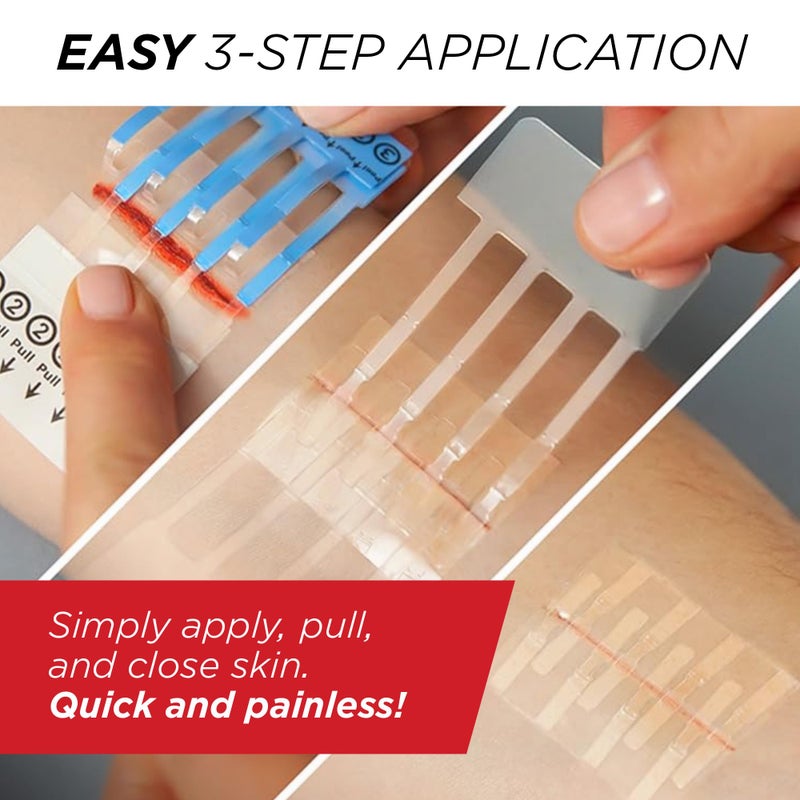 Clozex Emergency Laceration Closures - Repair Wounds Without Stitches, Skin Closure Device for 3 Individual Wounds Or Combine for Total Length of 4 1/4 Inches - Image 5