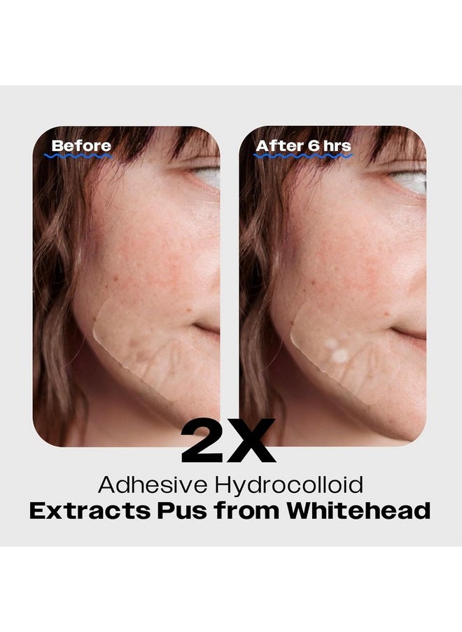 AVARELLE - Zitout Fit Large Hydrocolloid Pimple Patches (16 Patches) Vegan Nose Patches For Pores Tea Tree Chin Acne Patches For Face Hydrocolloid Bandages For Acne Fsa & Hsa Acne Treatment - Image 1