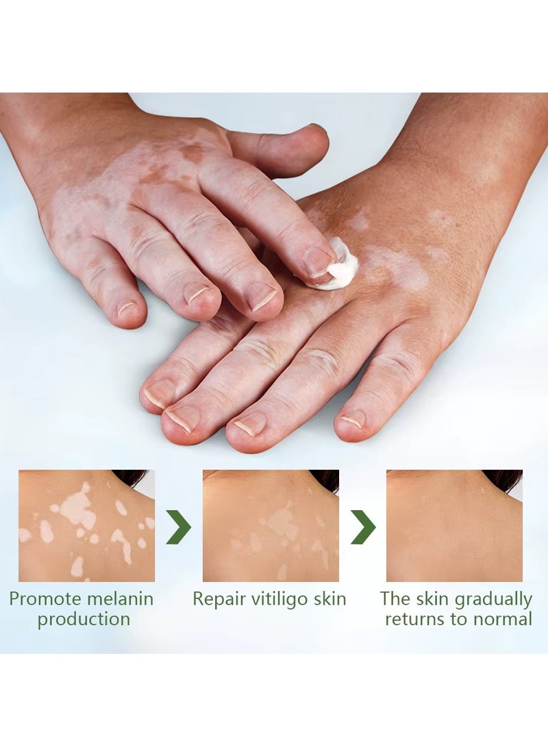 سوميفون صندوق كريم العناية بالبهاق من سومفون، 30 جرام، كريم إصلاح مكثف للبشرة لعلاج البهاق، والبقع البيضاء، ويعيد لون البشرة، مثالي للبقع البيضاء، والنمش، والبقع الشمسية، ويعزز تغذية البشرة وإصلاحها - Image 5