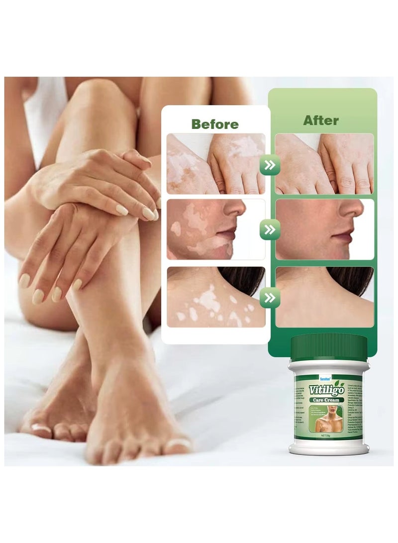 سوميفون صندوق كريم العناية بالبهاق من سومفون، 30 جرام، كريم إصلاح مكثف للبشرة لعلاج البهاق، والبقع البيضاء، ويعيد لون البشرة، مثالي للبقع البيضاء، والنمش، والبقع الشمسية، ويعزز تغذية البشرة وإصلاحها - Image 4