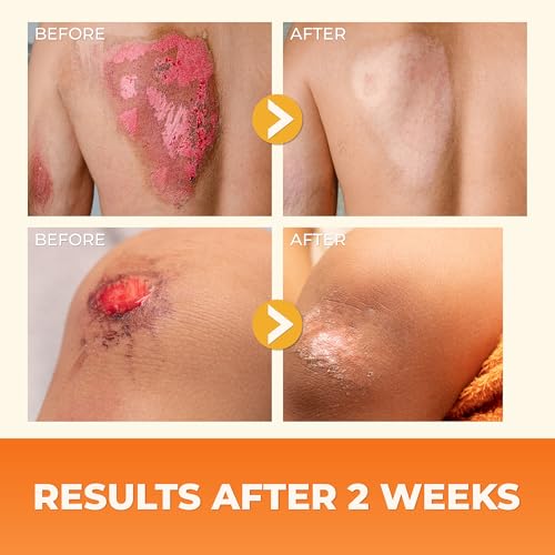 ABERA Red Turmeric Scar Cream - Protects Wounds and Regenerates Damaged Skin - Supports faster healing of skin wounds, scratches, and chafed areas (1 Box) - Image 5