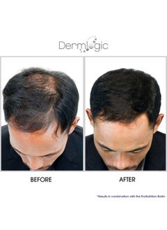 Dermlogic Hair Growth Serumextra Strength Dht Blocker Stimulates & Repairs New Follicle Regrowth. Grow Stronger Thicker Fuller Longer Healthier Hair. For Men & Women With No Side Effects.  - Image 4