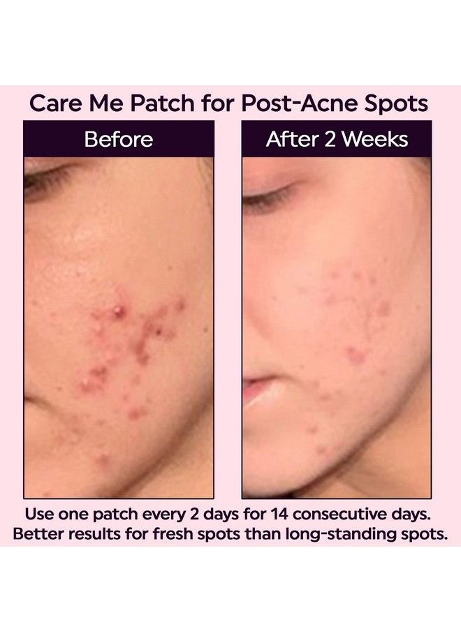 Care Me - Micropoint Patch For Dark Spots With 127 Micropoints Brightening Postblemish Dark Spots Skin Discoloration Pigmentation (9 Count/Pack) - Image 1