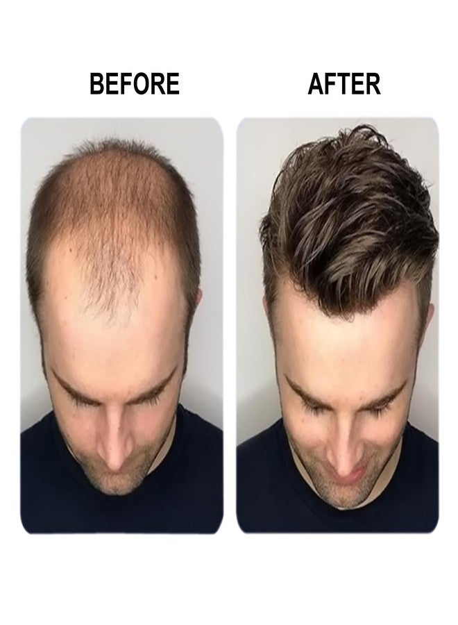 غلان شعر مستعار أحادي الخيوط من شعر بشري من GLAN، حل لتساقط الشعر، رقعة شعر/شعر مستعار سهل التركيب للمناطق الصلعاء للرجال والفتيان، عبوة من قطعة واحدة (بني داكن، 7 * 5) - Image 3