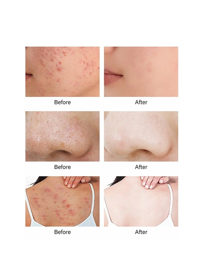 OUHOE Kojic Acid Soaf For Hyperpigmenta Tion ,With Turmeric & vitamin E & vitamin C Retinol Soap, Hyaluronic Acid Even Skin Tone ​Fade Dark Removing Spot and Acne Facial, Face and Body 100g  - Image 3