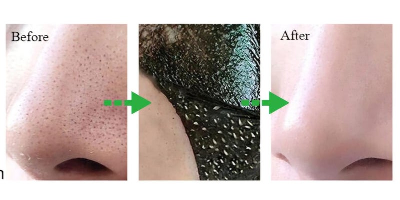 ETSAP شرائط إزالة الرؤوس السوداء (عبوة من 15) شرائط الأنف لإزالة الرؤوس السوداء، شرائط الفحم للتنظيف العميق مع إزالة فورية للرؤوس السوداء، منظف ومقلل المسام بالفحم الطبيعي (عبوة من 15) - Image 5