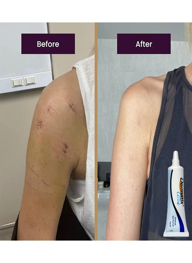 Dermatix Advanced Scar Gel 15g For Cosmetic Improvement of Scars, Fast Drying and Unique Silicone Gel Formulation, Used For Treatment of Keloids, Surgical and Hypertrophic Scars, Suitable For Sensitive Skin  - Image 3