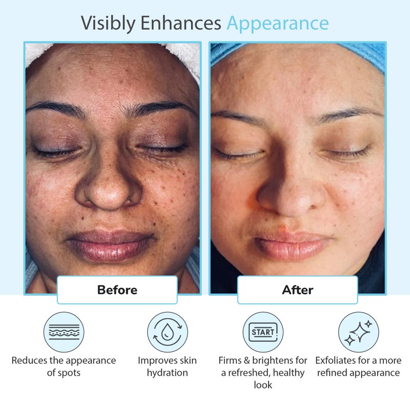 PERFECT IMAGE Glycolic Acid 50% Gel Peel - Enhanced with Retinol & Green Tea Extract (Professional Skin Peel)1 ounce - Image 5