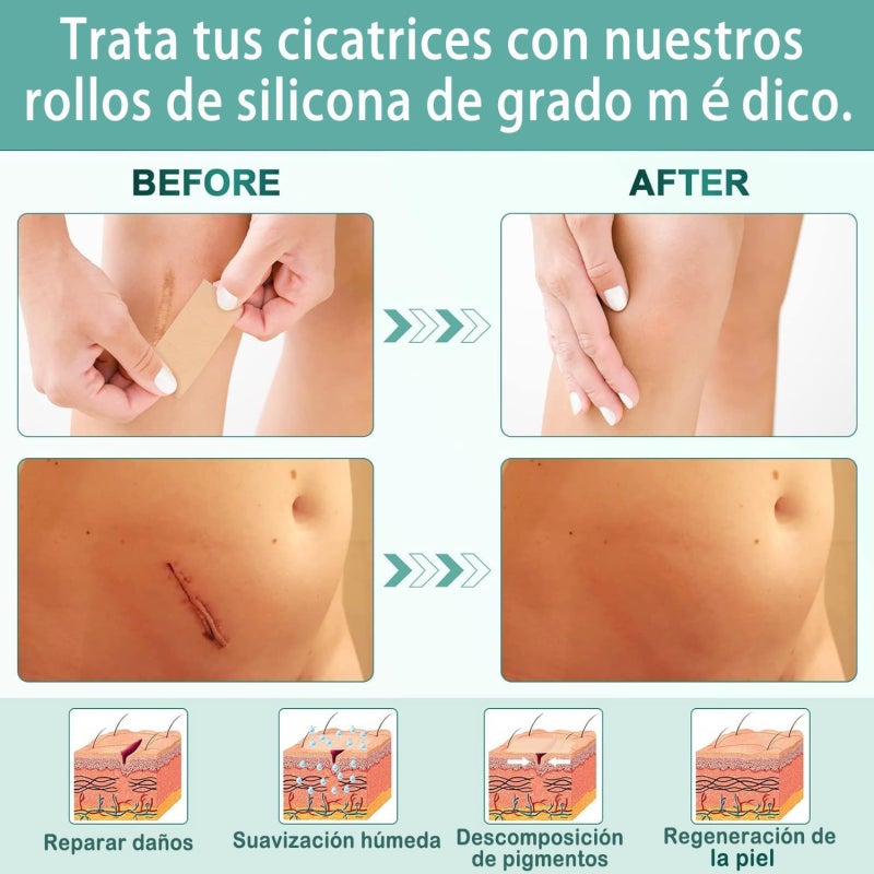 Silicone scar sticker, professional scar repair sticker, reusable, suitable for hypertrophic scars, postoperative scars, wounds, burns, stretch mark repair, skin regeneration, collagen sticker, scar wrinkle improvement, sensitive skin - Image 3