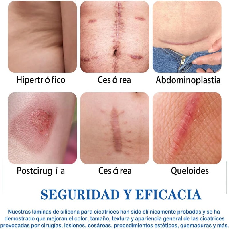 Silicone scar sticker, professional scar repair sticker, reusable, suitable for hypertrophic scars, postoperative scars, wounds, burns, stretch mark repair, skin regeneration, collagen sticker, scar wrinkle improvement, sensitive skin - Image 4