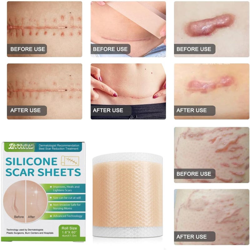 Silicone scar sticker, professional scar repair sticker, reusable, suitable for hypertrophic scars, postoperative scars, wounds, burns, stretch mark repair, skin regeneration, collagen sticker, scar wrinkle improvement, sensitive skin - Image 5