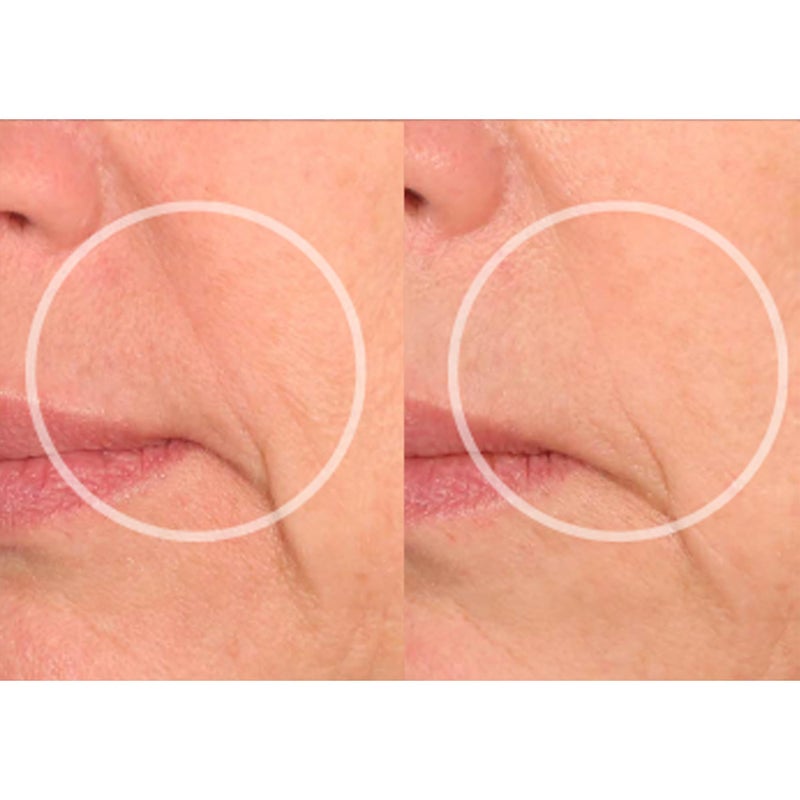 SiO Beauty Eye & Smile Lift - Eye & Smile Anti-Wrinkle Patches 2 Week Supply - Overnight Smoothing Silicone Patches for Wrinkles and Fine Lines - Image 5