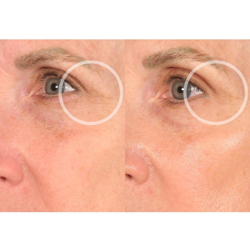 SiO Beauty Eye & Smile Lift - Eye & Smile Anti-Wrinkle Patches 2 Week Supply - Overnight Smoothing Silicone Patches for Wrinkles and Fine Lines - Image 3
