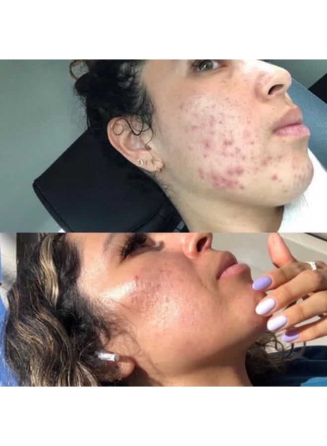 دكتور بن دكتور بين ألتيما A10 - قلم تجميل ميكرونيدل لاسلكي متعدد الوظائف أصلي - مجموعة أدوات العناية بالبشرة الموثوقة لتحقيق نتائج سريعة تحتوي على 2 قطعة من الإبر 12 - Image 2