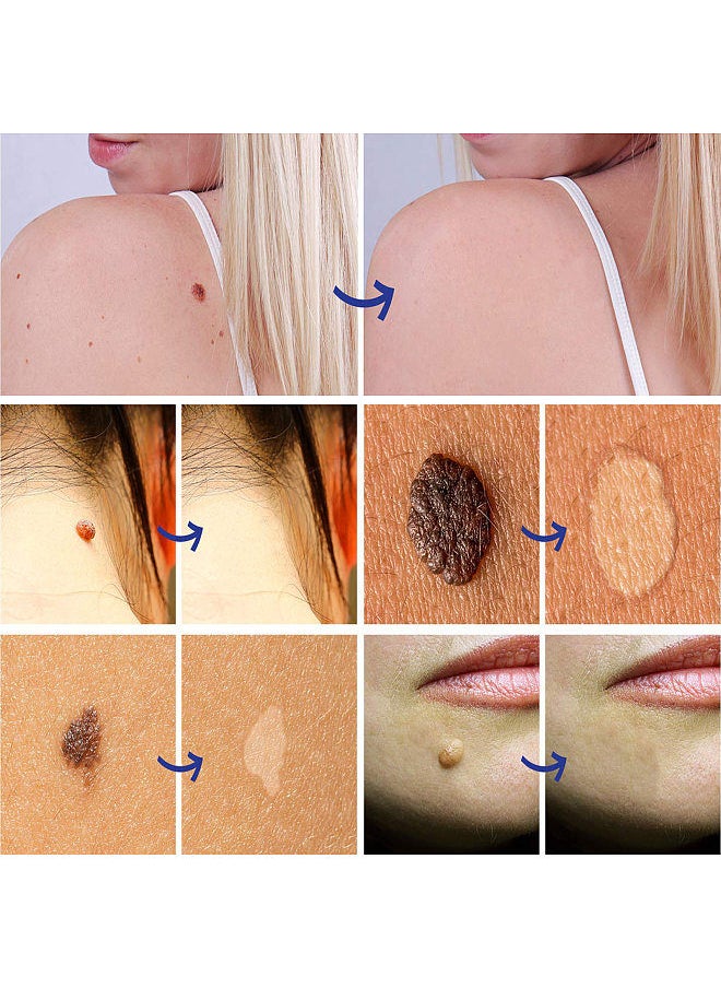 Sefudun - SEFUDUN Wart Removal Cream Skin Tag Remover Skin Tag Mole & Genital Wart Remover Foot Corn Removal Skin Care Tool - Image 1