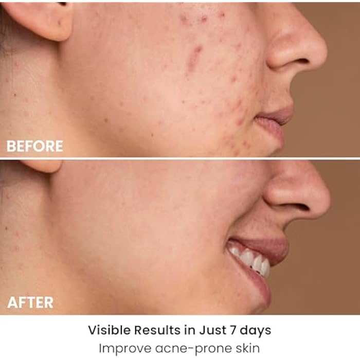 AMIRO قناع الوجه AMIRO Spectra للعلاج بالضوء 5 في 1، مع ضوء أزرق، أحمر، أخضر، أصفر، وأشعة تحت الحمراء، 3 أوضاع للبشرة الدهنية، المعرضة لحب الشباب، والمترهلة، العناية بالبشرة للوجه، فضي - Image 2