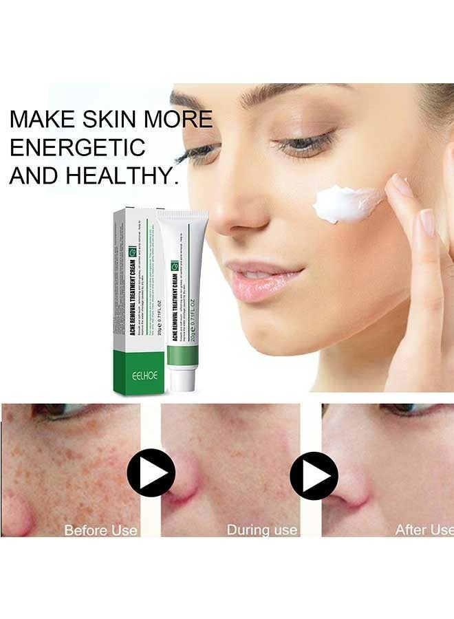 EELHOE Acne Removal Treatment Cream 20g, Quick Acne Removal, Fade Spots, Control Water And Oil Balance, Suitable For Oily And Acne Prone Skin, Oil Control Acne Cream - Image 1