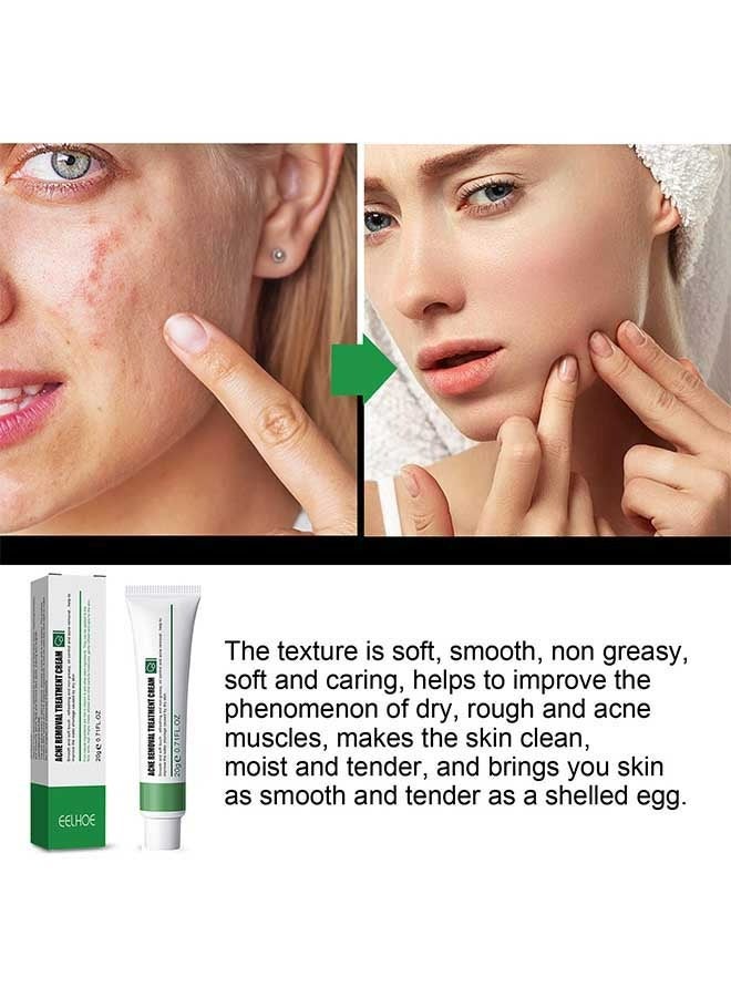 EELHOE Acne Removal Treatment Cream 20g, Quick Acne Removal, Fade Spots, Control Water And Oil Balance, Suitable For Oily And Acne Prone Skin, Oil Control Acne Cream - Image 4