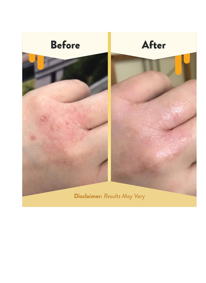 ECZEMA HONEY - ECZEMA HONEY Original Skin-Soothing Cream - Organic Hand & Body Eczema Relief - Natural Honey Lotion for Dry, Itchy, & Irritable Skin (4 Oz) - Image 1