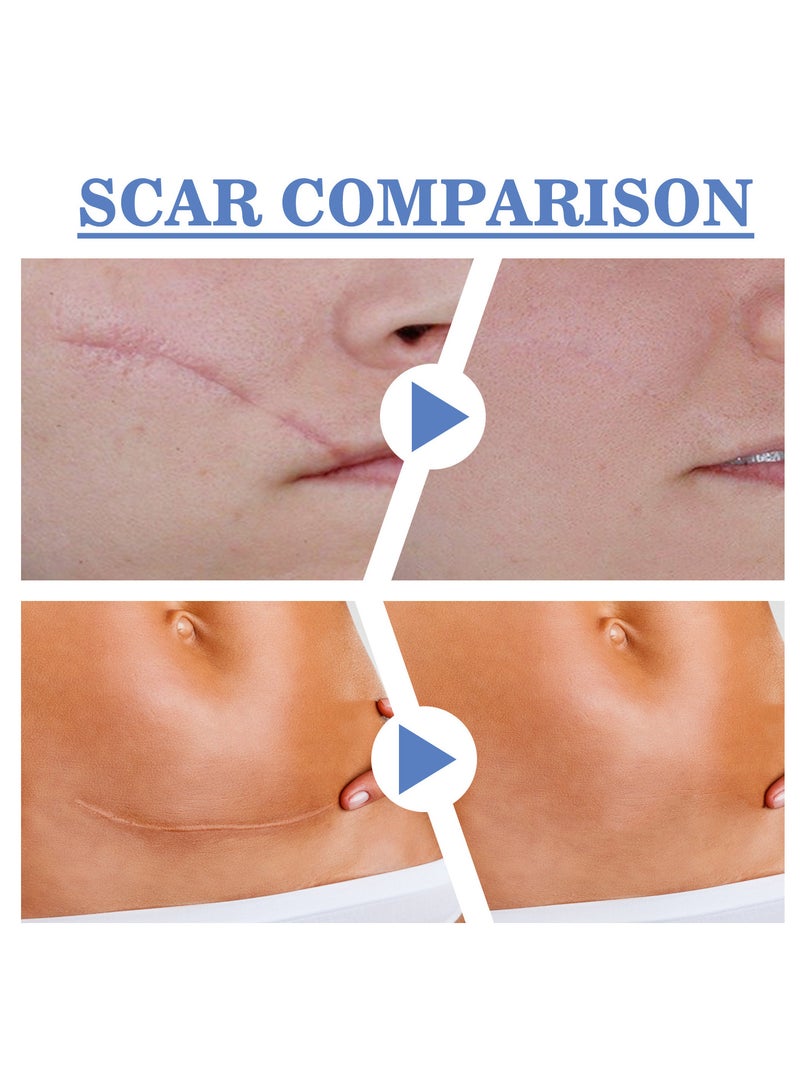 SOUTH MOON 4cm*1.5m Silicone Scar Sheets - Fade Scar Sticker, As Surgical Cream, Gel, Tape, Strips, Patches - Keloid, C-Section, Tummy Tuck - Surgery Scars Removal Treatment - Image 4