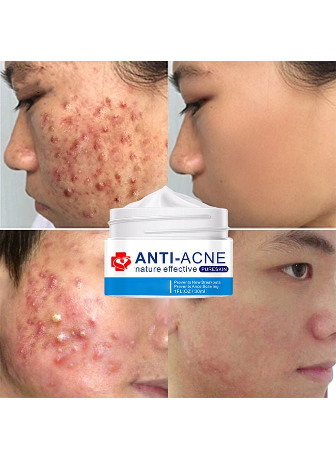 Acne Treatment Face Cream, Acne Spot Treatment for Face and Acne Dots, Natural Cystic Acne Treatment, For All Skin Types, Premium Acne Scar Cream and Pimple Remover, 30ML