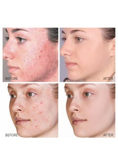 Jaysuing Acne Treatment Face Cream, Acne Spot Treatment for Face and Acne Dots, Natural Cystic Acne Treatment, For All Skin Types, Premium Acne Scar Cream and Pimple Remover, 30ML  - Image 5