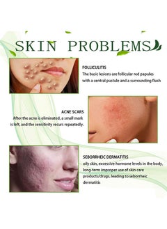Jaysuing Acne Treatment Face Cream, Acne Spot Treatment for Face and Acne Dots, Natural Cystic Acne Treatment, For All Skin Types, Premium Acne Scar Cream and Pimple Remover, 30ML  - Image 3