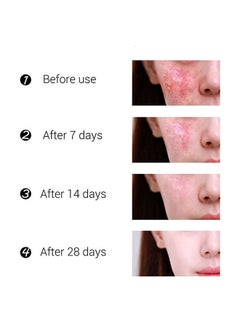 Jaysuing Acne Treatment Face Cream, Acne Spot Treatment for Face and Acne Dots, Natural Cystic Acne Treatment, For All Skin Types, Premium Acne Scar Cream and Pimple Remover, 30ML  - Image 4