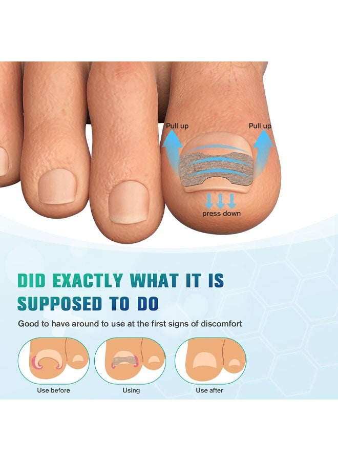 50 PCS Breathable Ingrown Toenail Corrector Patch with Double-Ended Stainless Steel Toenail Lifter – Comprehensive Toenail Care Solution - Image 4