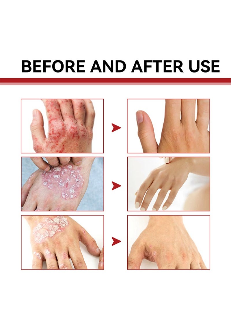 SOUTH MOON - Psoriasis Relief Cream with 0.35% Chlorhexidine Acetate, Herbal Formula Antibacterial Cream Full Body Psoriasis Moisturizer Natural Repair Antibacterial Soothing Exfoliating Rough Skin Care - Image 1