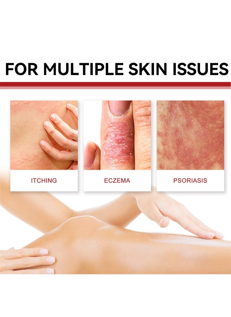 SOUTH MOON - Psoriasis Relief Cream with 0.35% Chlorhexidine Acetate, Herbal Formula Antibacterial Cream Full Body Psoriasis Moisturizer Natural Repair Antibacterial Soothing Exfoliating Rough Skin Care - Image 1