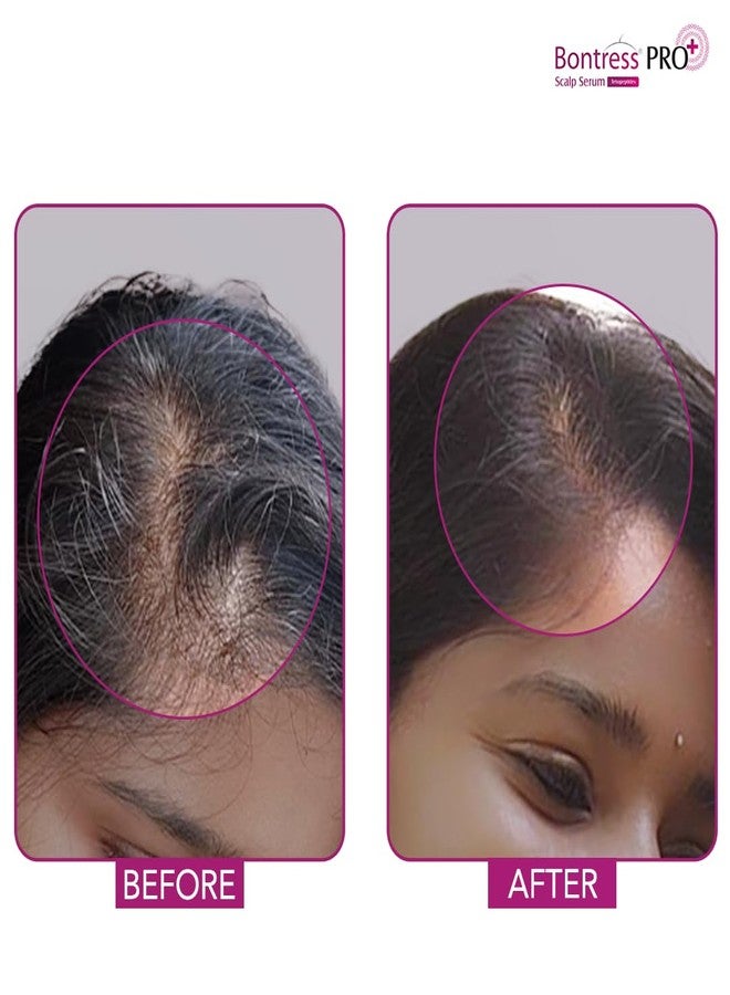 Bontress PRO+ Scalp Serum Fortified with Redensyl, Anagain, Capixyl,Procapil | Hair Serum for Hair Growth & Hair Fall 30ml - Image 5
