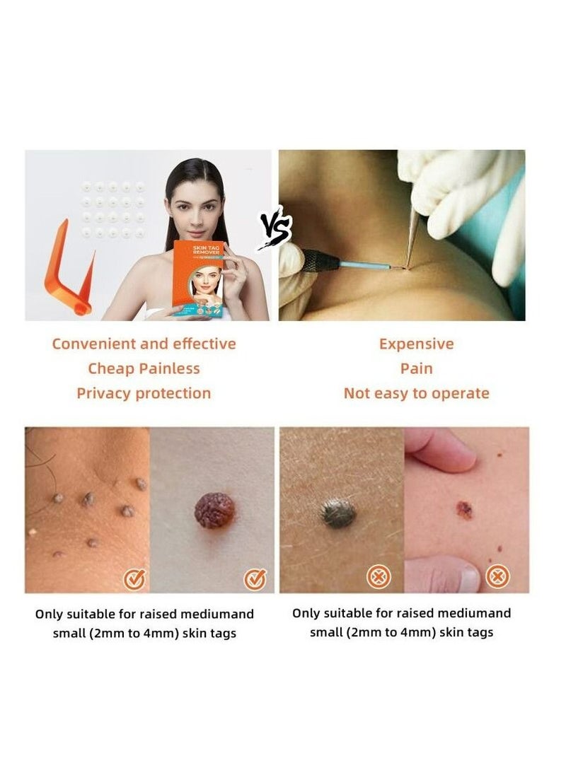 Kanza Micro Skin Tag Removal Kit - Painless Skin Tag Remover for Most Body Parts - Safe for Small (2mm) to Medium (5mm) Skin Tags  - Image 2